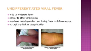 Defeverscence dengue fever protocol-1.pptx