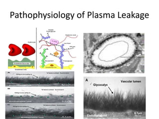 Pathophysiology of Plasma Leakage
 