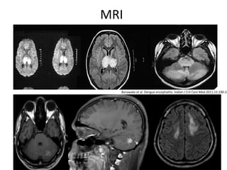 MRI
Borawake et al. Dengue encephalitis. Indian J Crit Care Med.2011;15:190-3
 