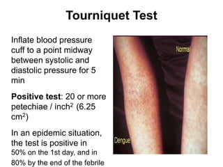 Tourniquet Test
Inflate blood pressure
cuff to a point midway
between systolic and
diastolic pressure for 5
min
Positive test: 20 or more
petechiae / inch2 (6.25
cm2)
In an epidemic situation,
the test is positive in
50% on the 1st day, and in
80% by the end of the febrile
 