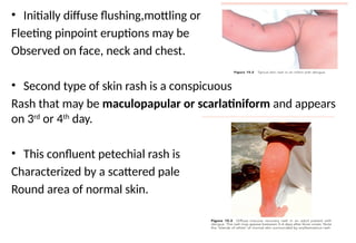 Scarltinaform Rash dengue fever , clinical features, diagnosis and treatment | PPTX