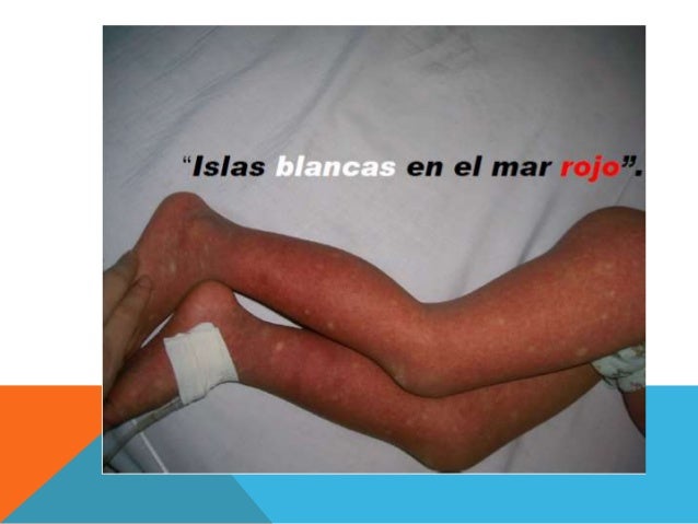 Dengue pediatria