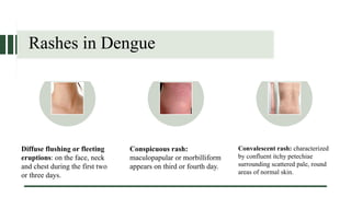 Updated Dengue Case Management Guideline (2024) | PPTX