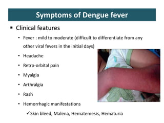 Symptoms of Dengue fever
 Clinical features
• Fever : mild to moderate (difficult to differentiate from any
other viral fevers in the initial days)
• Headache
• Retro-orbital pain
• Myalgia
• Arthralgia
• Rash
• Hemorrhagic manifestations
Skin bleed, Malena, Hematemesis, Hematuria
 