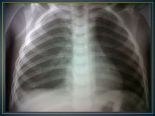 24/8/11 EVOLUCIONPaciente  a quien se obtiene resultado de frote periférico reportando leucopenia, hematólogo solicita hematología y Dengue IgM control; ya que se le comenta caso y por hallazgos en frote no descarta que paciente haya cursado con Dengue .