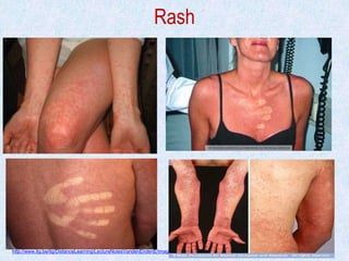 Rash
http://www.itg.be/itg/DistanceLearning/LectureNotesVandenEndenE/imagehtml/ppages/CD_1038_061c.htm. Used with permission
 