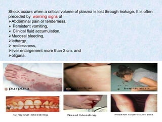 Shock occurs when a critical volume of plasma is lost through leakage. It is often
preceded by warning signs of
Abdominal pain or tenderness,
 Persistent vomiting,
 Clinical fluid accumulation,
Mucosal bleeding,
lethargy,
 restlessness,
liver enlargement more than 2 cm. and
oliguria.
 