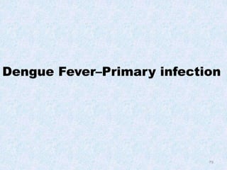 79
Dengue Fever–Primary infection
 