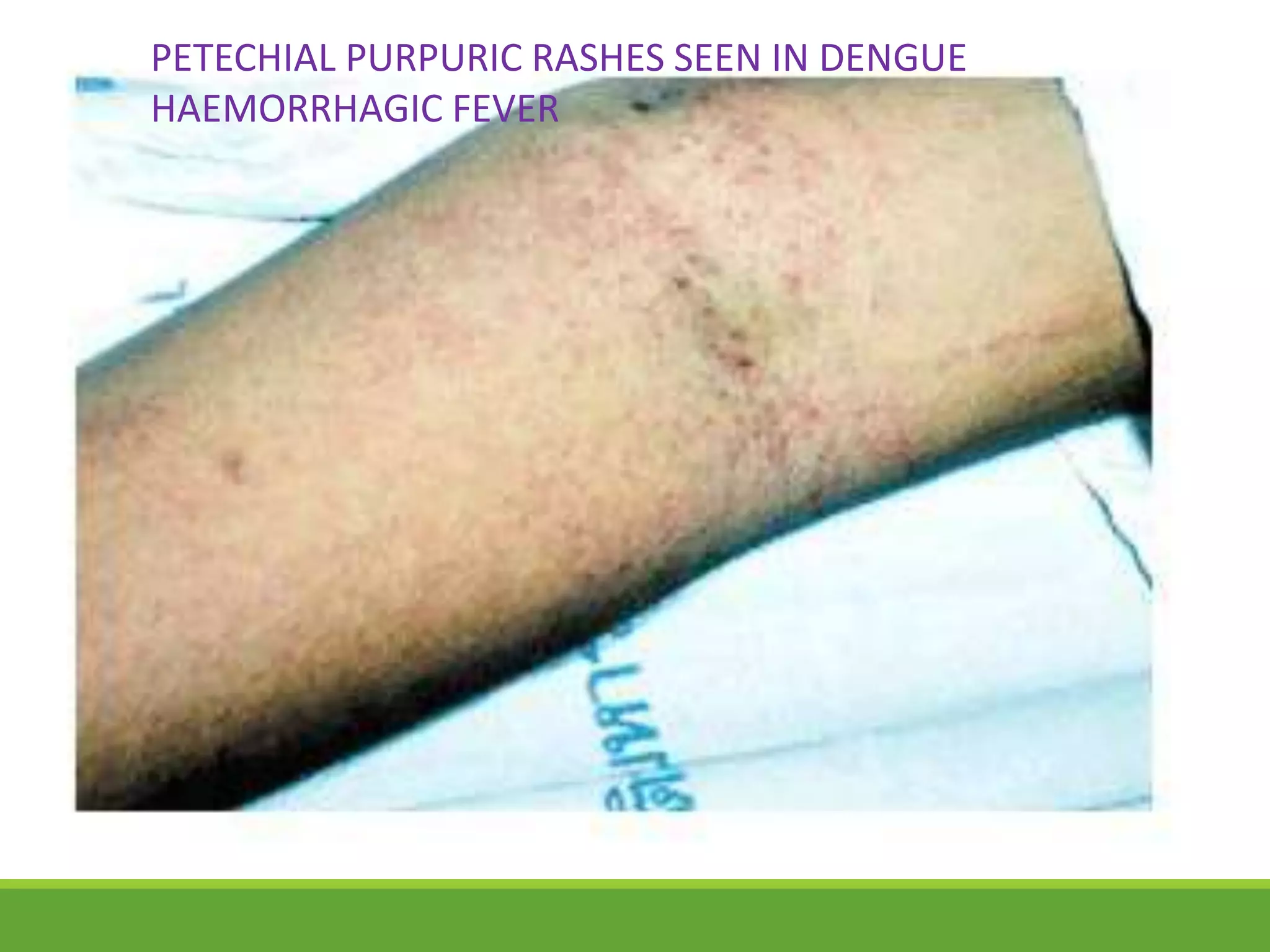 PETECHIAL PURPURIC RASHES SEEN IN DENGUE
HAEMORRHAGIC FEVER
 