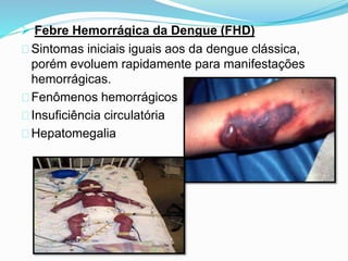  Febre Hemorrágica da Dengue (FHD)
Sintomas iniciais iguais aos da dengue clássica,
porém evoluem rapidamente para manifestações
hemorrágicas.
Fenômenos hemorrágicos
Insuficiência circulatória
Hepatomegalia
 