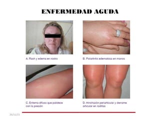 ENFERMEDAD AGUDA
26/11/15
 