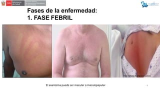Fases de la enfermedad:
1. FASE FEBRIL
El exantema puede ser macular o maculopapular 8
Foto: Alfredo Rodríguez Cuadrado
 