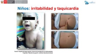 Niños: irritabilidad y taquicardia
Fuente: Hospital de Apoyo Iquitos, Centro de Investigación en Enfermedades
Tropicales “...