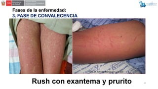 Fases de la enfermedad:
3. FASE DE CONVALECENCIA
Rush con exantema y prurito 20
Foto: Dr. Alfredo Rodríguez Cuadrado
 