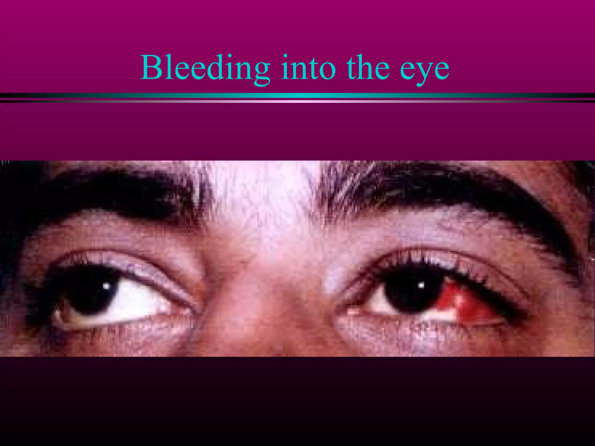 Bleeding into the eye

 