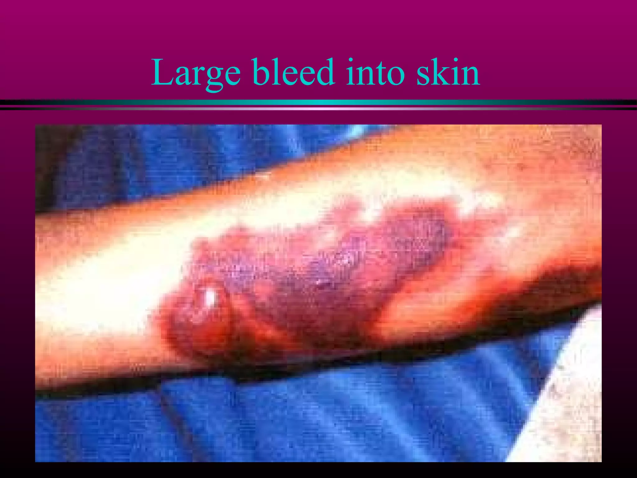 Large bleed into skin

 