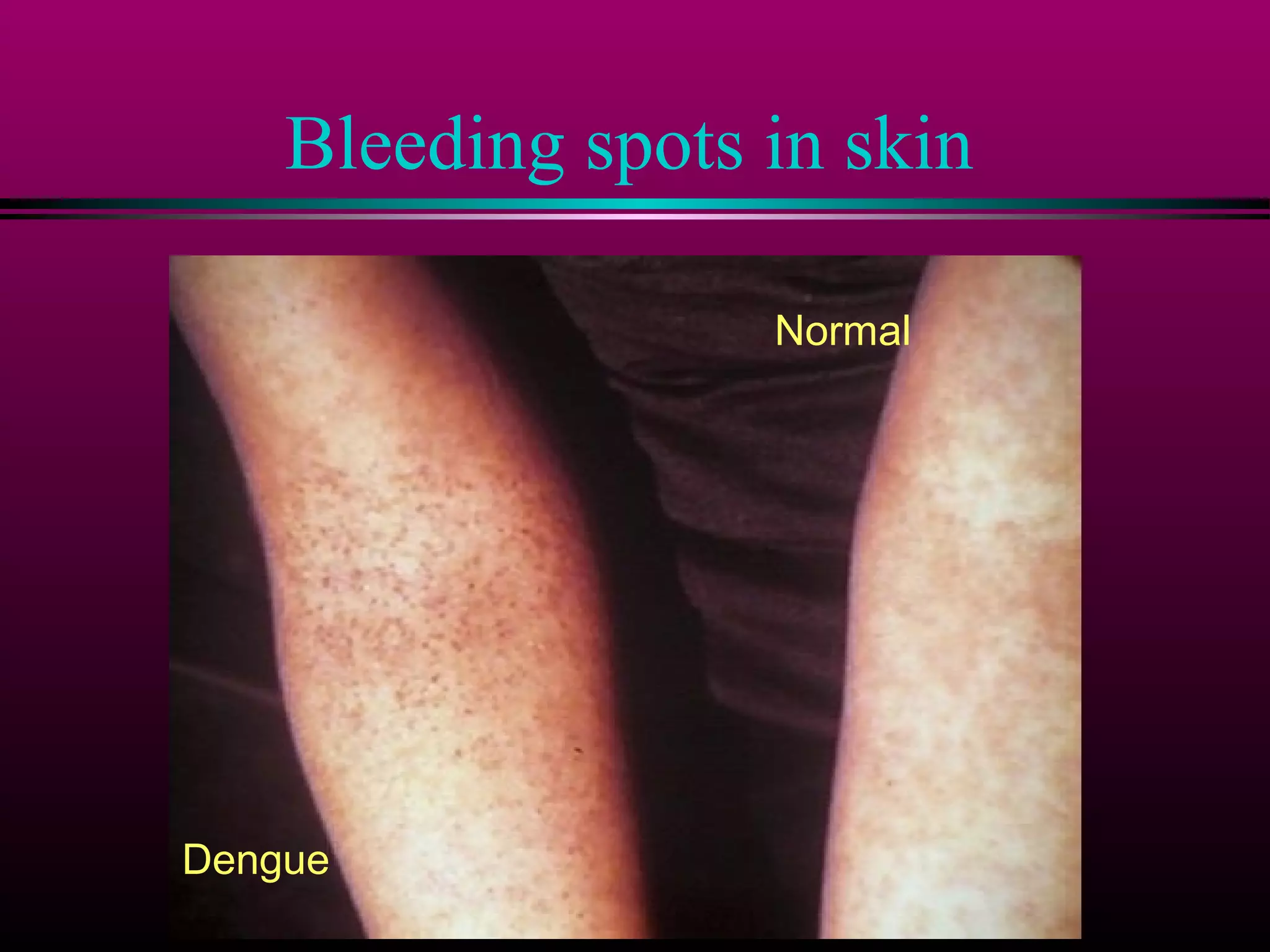 Bleeding spots in skin
Normal

Dengue

 