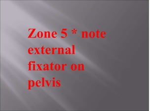 Zone 5 * note
external
fixator on
pelvis
 