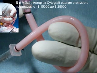 Д-р Макаллистер из Cytograft оценил стоимость процедуры от $ 15000 до $ 25000 