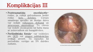 • Posttraumatiska encefalocēle-
rodas, ja vidējā galvaskausa bedrē
rodas liels defekts. Cietais
smadzeņu apvalks un deniņu daiva
var nokļūt vidusauss dobumā un
processus mastoideus. To citreiz
var redzēt otoskopiski kā balta masa
ar asinsvadiem aiz bungplēvītes.
• Perilimfātiska fistula- var veidoties
pie OCD vai stapes subluksācijas
ovālajā atverē. Tā izpaužas kā
periodisks vertigo un SN dzirdes
zudums. http://www.hindawi.com/journals/criot/2014/271824/fig1/
Komplikācijas III
 