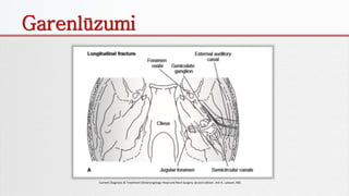 Garenlūzumi
Current Diagnosis & Treatment Otolaryngology Head and Neck Surgery second edition. Anil K. Lalwani, MD.
 