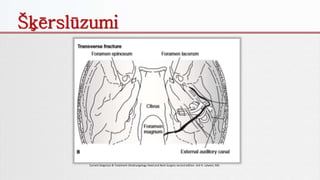 Šķērslūzumi
Current Diagnosis & Treatment Otolaryngology Head and Neck Surgery second edition. Anil K. Lalwani, MD.
 
