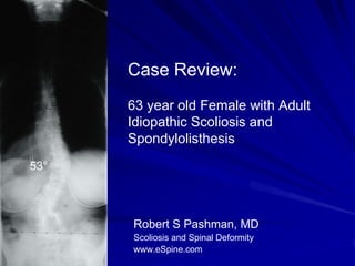 Case Review:
      63 year old Female with Adult
      Idiopathic Scoliosis and
      Spondylolisthesis
53°



      Robert S Pashman, MD
      Scoliosis and Spinal Deformity
      www.eSpine.com
 