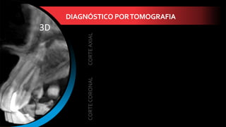 DIAGNÓSTICO PORTOMOGRAFIA
CORTE
AXIAL
CORTE
CORONAL
 