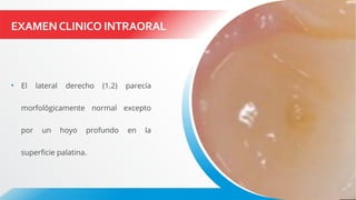 EXAMENCLINICO INTRAORAL
• El lateral derecho (1.2) parecía
morfológicamente normal excepto
por un hoyo profundo en la
superficie palatina.
 