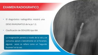 EXAMEN RADIOGRAFICO
• El diagnóstico radiográfico mostró una
DENS INVAGINATUS de la pz 1.2.
• Clasificación de OEHLERS tipo IIIA
La invaginación penetra a través de la raíz y se
comunica apical o lateralmente en el foramen,
algunas veces se refiere como un “segundo
foramen” en la raíz.
 