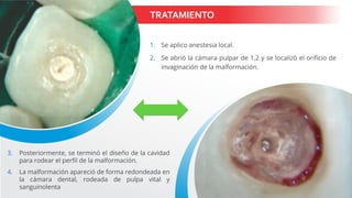 TRATAMIENTO
1. Se aplico anestesia local.
2. Se abrió la cámara pulpar de 1,2 y se localizó el orificio de
invaginación de la malformación.
3. Posteriormente, se terminó el diseño de la cavidad
para rodear el perfil de la malformación.
4. La malformación apareció de forma redondeada en
la cámara dental, rodeada de pulpa vital y
sanguinolenta
 