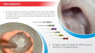 TRATAMIENTO
5. El orificio central se reconoció y se amplió con las fresas Gates Glidden
en sucesión del N ° 1-3 para facilitar la inserción suave de la lima K 8 en
el conducto del tracto y para aumentar el diámetro hasta alcanzar el
espacio periodontal
6. El tejido pulpar de DENS IN DENTE parecía
necrótico y no sanguinolento.
 