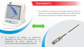 TRATAMIENTO
7. Era necesaria la extracción de la pulpa vital; por tanto, se
utilizó una sonda puntiaguda alrededor de la malformación
para localizar el acceso al conducto radicular principal
8. La longitud de trabajo se determinó
utilizando una lima K 0.8 conectada a un
localizador de ápice, seguido de la
confirmación de la radiografía periapical.
Root ZX, Morita, Tokio, Japón
 
