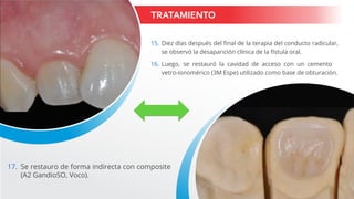 TRATAMIENTO
15. Diez días después del final de la terapia del conducto radicular,
se observó la desaparición clínica de la fístula oral.
16. Luego, se restauró la cavidad de acceso con un cemento
vetro-ionomérico (3M Espe) utilizado como base de obturación.
17. Se restauro de forma indirecta con composite
(A2 GandioSO, Voco).
 