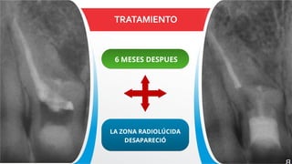 TRATAMIENTO
6 MESES DESPUES
LA ZONA RADIOLÚCIDA
DESAPARECIÓ
 