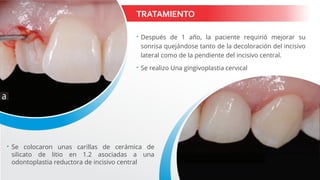TRATAMIENTO
 Después de 1 año, la paciente requirió mejorar su
sonrisa quejándose tanto de la decoloración del incisivo
lateral como de la pendiente del incisivo central.
 Se realizo Una gingivoplastia cervical
 Se colocaron unas carillas de cerámica de
silicato de litio en 1.2 asociadas a una
odontoplastia reductora de incisivo central
 