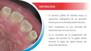 DEFINICIÓN
• El término (DENS IN DENTE) indica la
apariencia radiográfica de un aparente
diente que se ha formado dentro de otro.
• Dens invaginatus es una anomalía del
desarrollo que rara vez ocurre. 
• Es el resultado de la invaginación del
órgano del esmalte en la papila dental
durante la etapa de tejido blando del
desarrollo del diente.
 