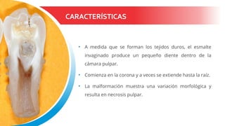 CARACTERÍSTICAS
• A medida que se forman los tejidos duros, el esmalte
invaginado produce un pequeño diente dentro de la
cámara pulpar.
• Comienza en la corona y a veces se extiende hasta la raíz.
• La malformación muestra una variación morfológica y
resulta en necrosis pulpar.
 