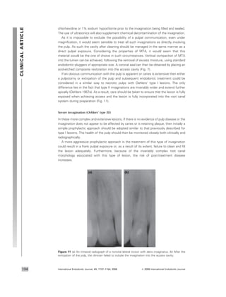 chlorhexidine or 1% sodium hypochlorite prior to the invagination being ﬁlled and sealed.
The use of ultrasonics will also supplement chemical decontamination of the invagination.
As it is impossible to exclude the possibility of a pulpal communication, even under
magniﬁcation, it would seem sensible to treat all such invaginations as directly involving
the pulp. As such the cavity after cleaning should be managed in the same manner as a
direct pulpal exposure. Considering the properties of MTA, it would seem that this
material would be the one of choice in such circumstances. Vertical compaction of MTA
into the lumen can be achieved, following the removal of excess moisture, using standard
endodontic pluggers of appropriate size. A coronal seal can then be obtained by placing an
acid-etched composite restoration into the access cavity (Fig. 7).
If an obvious communication with the pulp is apparent or caries is extensive then either
a pulpotomy or extirpation of the pulp and subsequent endodontic treatment could be
considered in a similar way to necrotic pulps with Oehlers’ type I lesions. The only
difference lies in the fact that type II invaginations are invariably wider and extend further
apically (Oehlers 1957a). As a result, care should be taken to ensure that the lesion is fully
exposed when achieving access and the lesion is fully incorporated into the root canal
system during preparation (Fig. 11).
Severe invagination (Oehlers’ type III)
In these more complex and extensive lesions, if there is no evidence of pulp disease or the
invagination does not appear to be affected by caries or is retaining plaque, then initially a
simple prophylactic approach should be adopted similar to that previously described for
type I lesions. The health of the pulp should then be monitored closely both clinically and
radiographically.
A more aggressive prophylactic approach in the treatment of this type of invagination
could result in a frank pulpal exposure or, as a result of its extent, failure to clean and ﬁll
the lesion adequately. Furthermore, because of the invariably complex root canal
morphology associated with this type of lesion, the risk of post-treatment disease
increases.
(a) (b)
Figure 11 (a) An intraoral radiograph of a nonvital lateral incisor with dens invaginatus. (b) After the
extirpation of the pulp, the clinician failed to include the invagination into the access cavity.
CLINICALARTICLE
International Endodontic Journal, 41, 1137–1154, 2008 ª 2008 International Endodontic Journal1148
 