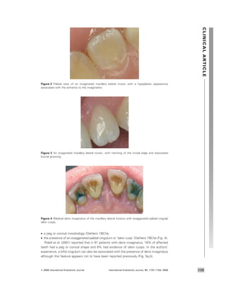 • a peg or conical morphology (Oehlers 1957a);
• the presence of an exaggerated palatal cingulum or ‘talon cusp’ (Oehlers 1957a) (Fig. 4).
Ridell et al. (2001) reported that in 91 patients with dens invaginatus, 16% of affected
teeth had a peg or conical shape and 9% had evidence of talon cusps. In the authors’
experience, a biﬁd cingulum can also be associated with the presence of dens invaginatus
although this feature appears not to have been reported previously (Fig. 5a,b).
Figure 3 An invaginated maxillary lateral incisor, with notching of the incisal edge and associated
buccal grooving.
Figure 2 Palatal view of an invaginated maxillary lateral incisor with a hypoplastic appearance
associated with the entrance to the invagination.
Figure 4 Bilateral dens invaginatus of the maxillary lateral incisors with exaggerated palatal cingula/
talon cusps.
CLINICALARTICLE
ª 2008 International Endodontic Journal International Endodontic Journal, 41, 1137–1154, 2008 1139
 