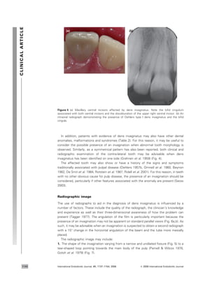 In addition, patients with evidence of dens invaginatus may also have other dental
anomalies, malformations and syndromes (Table 2). For this reason, it may be useful to
consider the possible presence of an invagination when abnormal tooth morphology is
observed. Similarly, as a symmetrical pattern has also been reported, both clinical and
radiographic examination of the contra-lateral tooth may be advisable when dens
invaginatus has been identiﬁed on one side (Grahnen et al. 1959) (Fig. 4).
The affected tooth may also show or have a history of the signs and symptoms
traditionally associated with pulpal disease (Oehlers 1957b, Omnell et al. 1960, Beynon
1982, De Smit et al. 1984, Rotstein et al. 1987, Ridell et al. 2001). For this reason, in teeth
with no other obvious cause for pulp disease, the presence of an invagination should be
considered, particularly if other features associated with the anomaly are present (Seow
2003).
Radiographic image
The use of radiographs to aid in the diagnosis of dens invaginatus is inﬂuenced by a
number of factors. These include the quality of the radiograph, the clinician’s knowledge
and experience as well as their three-dimensional awareness of how the problem can
present (Tagger 1977). The angulation of the ﬁlm is particularly important because the
presence of an invagination may not be apparent on standard parallel views (Fig. 6a,b). As
such, it may be advisable when an invagination is suspected to obtain a second radiograph
with a 15° change in the horizontal angulation of the beam and the tube more mesially
placed.
The radiographic image may include:
1. The shape of the invagination varying from a narrow and undilated ﬁssure (Fig. 5) to a
tear-shaped loop pointing towards the main body of the pulp (Parnell & Wilcox 1978,
Gotoh et al. 1979) (Fig. 7).
(a) (b)
Figure 5 (a) Maxillary central incisors affected by dens invaginatus. Note the biﬁd cingulum
associated with both central incisors and the discolouration of the upper right central incisor. (b) An
intraoral radiograph demonstrating the presence of Oehlers type I dens invaginatus and the biﬁd
cingula.
CLINICALARTICLE
International Endodontic Journal, 41, 1137–1154, 2008 ª 2008 International Endodontic Journal1140
 