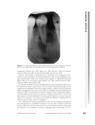 invaginations (Rotstein et al. 1987, Rakes et al. 1988, Hu¨lsmann 1995b, de Sousa &
Bramante 1998, Seow 2003, Pandey & Pandey 2005, Stamfelj et al. 2007).
However, with a greater understanding of the morphology of the invagination and its
association with pulp disease, preventive procedures to seal minimal invaginations have
been recommended. These have involved varying degrees of intervention (Parnell &
Wilcox 1978, De Smit & Demaut 1982, Rotstein et al. 1987, Szajkis & Kaufman 1993,
Hu¨lsmann 1995b, Hosey & Bedi 1996).
For example, a number of authors have advocated an invasive prophylactic approach in
the treatment of Oehlers’ type II lesions. This has involved coronal instrumentation of the
invagination and subsequent ﬁlling with amalgam (Holtzman 1998, de Sousa & Bramante
1998) or gutta-percha (Tsurumachi et al. 2002). An alternative technique described by
Ridell et al. (2001) involved ﬁlling with calcium hydroxide and zinc-oxide/eugenol together
with either glass–ionomer cement, composite or amalgam. Unfortunately, 11.3% of the
teeth treated in this study developed irreversible pulpal complications requiring root canal
treatment or extraction. This outcome may reﬂect the difﬁculty in dealing with the
aberrant anatomy present within the invagination.
If an invaginated tooth develops pulp disease or has a high risk of doing so, the need for
root canal treatment is unavoidable if extraction is not an option. Grossman (1974) and
Creaven (1975) were the ﬁrst to describe the use of conventional endodontic techniques
and materials in the treatment of severely invaginated teeth. Unfortunately, such an
Figure 8 An intraoral radiograph of a nonvital mandibular premolar with dens invaginatus. Note the
blunting of the pulpal outline, the associated atypical butterﬂy-shaped apical radiolucency.
CLINICALARTICLE
ª 2008 International Endodontic Journal International Endodontic Journal, 41, 1137–1154, 2008 1143
 