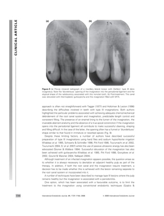 approach is often not straightforward with Tagger (1977) and Holtzman & Lezion (1996)
describing the difﬁculties involved in teeth with type III invaginations. Both authors
highlighted the particular problems associated with achieving adequate chemomechanical
debridement of the root canal system and invagination, predictable length control and
consistent ﬁlling. The presence of an enamel lining to the lumen of the invagination, the
invariable aberrant anatomy and the absence of a true apical constriction if the invagination
opens into the periodontal ligament all contribute to make successful cleaning, shaping
and ﬁlling difﬁcult. In the case of the latter, the opening often has a funnel or ‘blunderbuss’
shape similar to that found in immature or resorbed apices (Fig. 9).
Despite these limiting factors, a number of authors have described successful
preparation of type III invaginations using hand ﬁles and sodium hypochlorite irrigation
(Khabbaz et al. 1995, Schwartz & Schindler 1996, Pitt Ford 1998, Tsurumachi et al. 2002,
Tsurumachi 2004, Er et al. 2007) whilst the use of passive ultrasonic energy has also been
advocated (Skoner & Wallace 1994). Successful obturation of the invagination has also
been achieved with gutta-percha (Khabbaz et al. 1995, Pitt Ford 1998, Gonc¸alves et al.
2002, Gound & Maixner 2004, Nallapati 2004).
Although treatment of an infected invagination appears possible, the question arises as
to whether it is always necessary to devitalize an adjacent healthy pulp as part of the
therapy. In addition, if both the root canal and the invagination require treatment, a
decision has to be made whether this is achieved with the lesion remaining separate to
the root canal system or incorporated into it.
A number of techniques have been described to manage type III lesions where the pulp
remains healthy but the invagination is associated with a periodontitis.
One option, which has been associated with a favourable outcome, is to limit the
treatment to the invagination using conventional endodontic techniques (Szajkis &
(a) (b)
Figure 9 (a) Pre-op intraoral radiograph of a maxillary lateral incisor with Oehlers’ type III dens
invaginatus. Note the ‘blunderbuss’ opening of the invagination into the periodontal ligament and the
atypical shape of the radiolucency associated with this nonvital tooth. (b) Post-treatment. The canal
was obturated with thermoplastic gutta-percha and the invagination ﬁlled with MTA.
CLINICALARTICLE
International Endodontic Journal, 41, 1137–1154, 2008 ª 2008 International Endodontic Journal1144
 