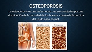 OSTEOPOROSIS
La osteoporosis es una enfermedad que se caracteriza por una
disminución de la densidad de los huesos a causa de la pérdida
del tejido óseo normal.
 