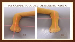 POSICIONAMENTO DO LASER EM APARELHOS HOLOGIC
DIR ESQ
 