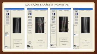 AQUISIÇÕES E ANÁLISES INCORRETAS
 