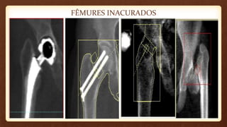 FÊMURES INACURADOS
 