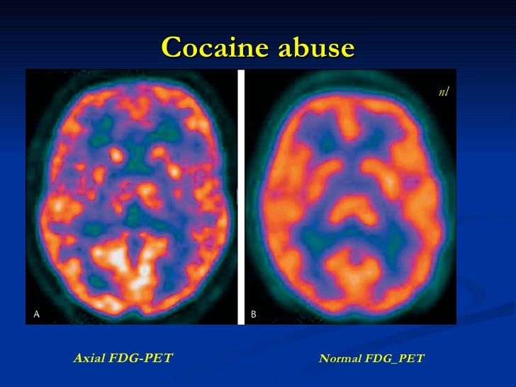 PET and SPECT Scanning: Functional Brain Imaging