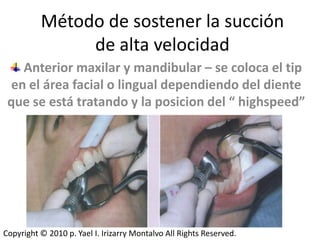 Método de sostener la succión
               de alta velocidad
    Anterior maxilar y mandibular – se coloca el tip
  en el área facial o lingual dependiendo del diente
 que se está tratando y la posicion del “ highspeed”




Copyright © 2010 p. Yael I. Irizarry Montalvo All Rights Reserved.
 