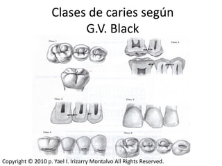 Clases de caries según
                          G.V. Black




Copyright © 2010 p. Yael I. Irizarry Montalvo All Rights Reserved.
 